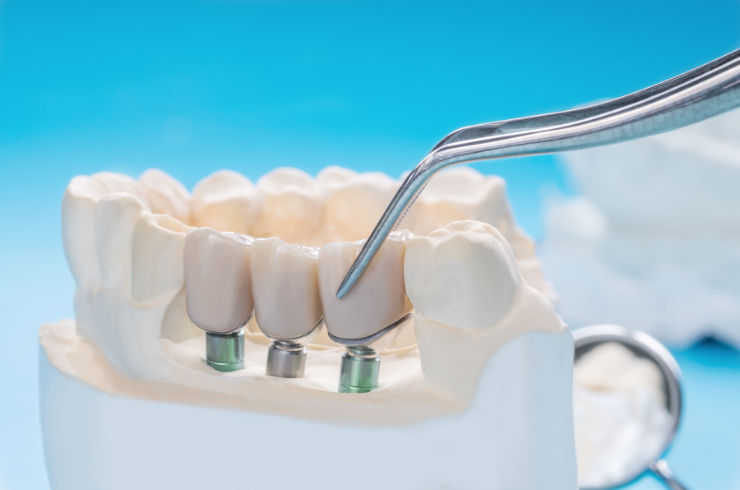 Dental Bridges