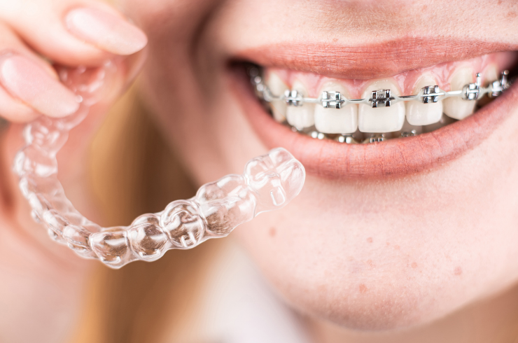 Braces & Aligners