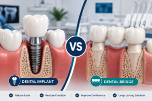 Implant Vs Bridge